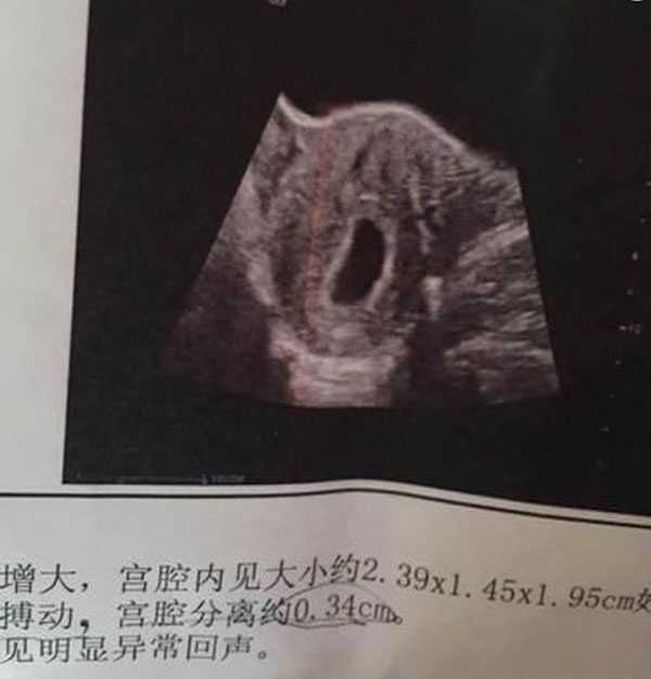 广州代妈成功怀上_子宫肌瘤有8cm大小，在进行试管婴儿的时候有哪些注意事项
