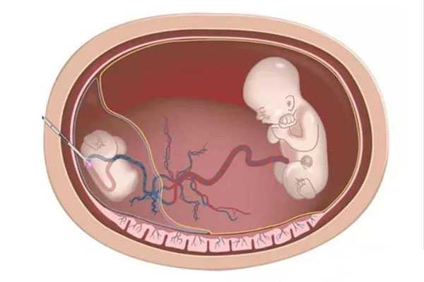 门头沟36岁试管婴儿生儿子准确吗_试管婴儿双胞胎减胎风险有哪些？了如指掌，