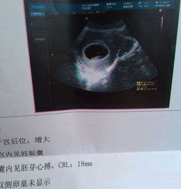 沧州不能生育代孕_沧州找一个愿意代孕的女孩容易吗_试管移植39天是正常怀孕