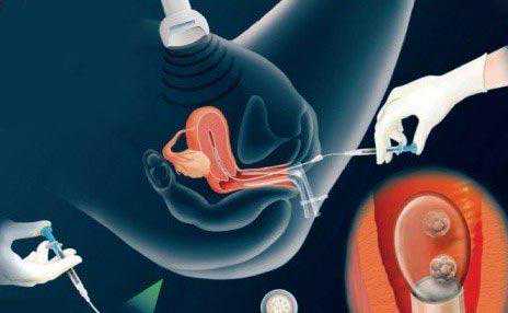 黔南垂体卵巢性不孕_试管婴儿和人工授精，哪个成功率高